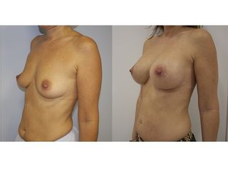 Antes y después Aumento de pecho