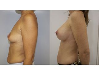 Antes y después Aumento de pecho