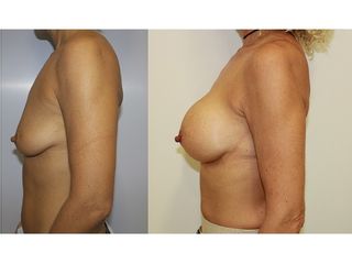 Antes y después Aumento de pecho