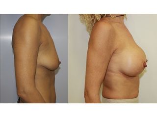 Antes y después Aumento de pecho