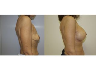 Antes y después Aumento de pecho