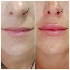 Aumento de labios - Clínicas Be