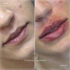 Aumento de labios - Clínicas Querales