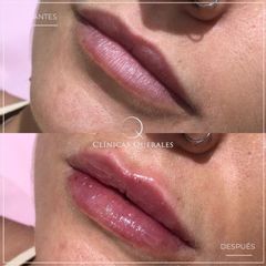 Aumento de labios - Clínicas Querales