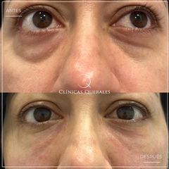 Eliminación de ojeras - Clínicas Querales