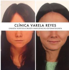 Bichectomía - Clínica Varela Reyes