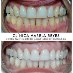 Blanqueamiento dental - Clínica Varela Reyes