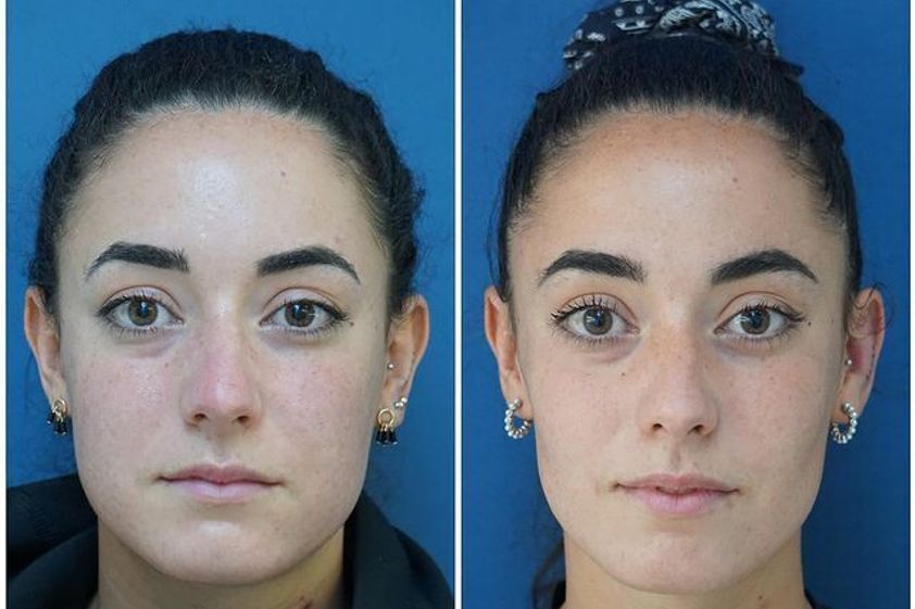 Bichectomía antes y después - 818882