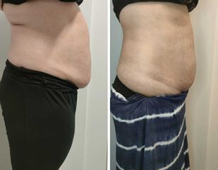 Mesoterapia - Clínica Montesinos
