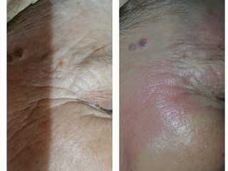 Mesoterapia contorno ojos