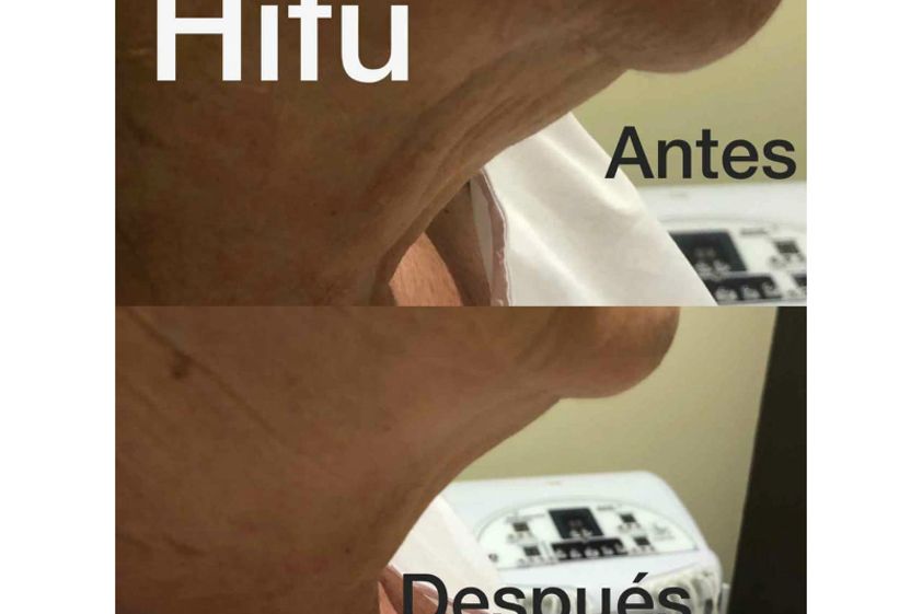 HIFU antes y después - 632996