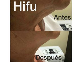 Hifu Hifu - Centro Ana Jurado