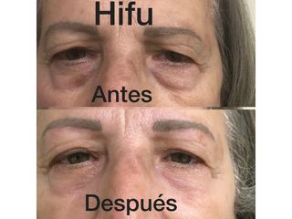 Hifu antes y después