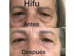 Hifu - Centro Ana Jurado