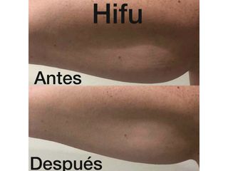 Hifu brazos - Centro Ana Jurado