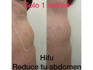 Hifu abdomen - Centro Ana Jurado
