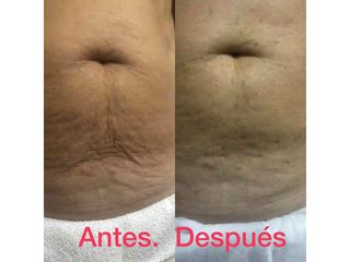 Hifu abdomen - Centro Ana Jurado