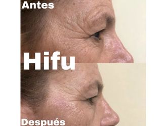 HIFU - 633001