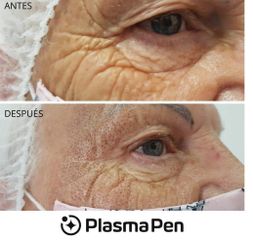 Blefaroplastia con PlasmaPen - Centro Ana Jurado