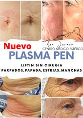 Plasma Pen - Spa y Belleza Ana Jurado