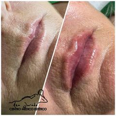 Aumento de labios - Centro Ana Jurado