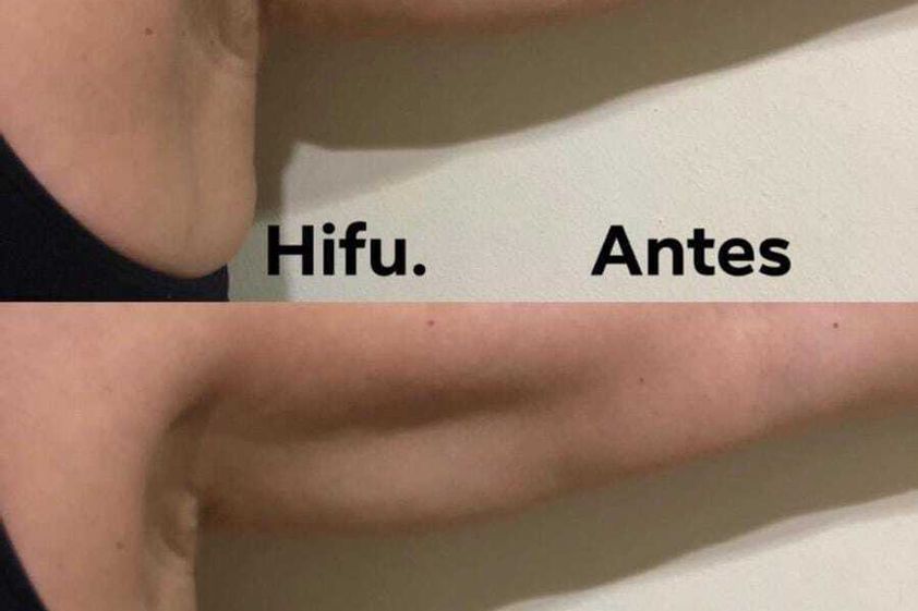 HIFU antes y después - 821105