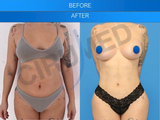 Bikini makeover