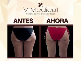 Liposucción - 643572