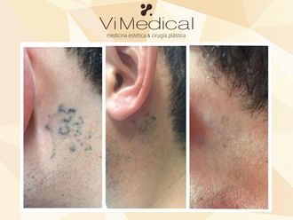 Eliminación de tatuajes - 644048