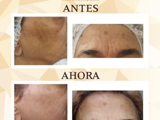 Rejuvenecimiento facial - 644245