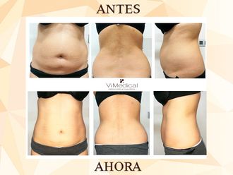 Tratamiento obesidad - 646446