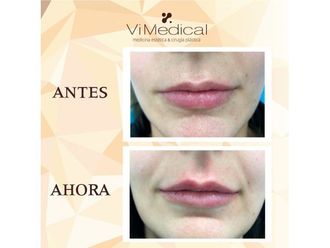 Aumento labios - 646854