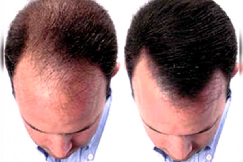 Alopecia antes y después - 837601
