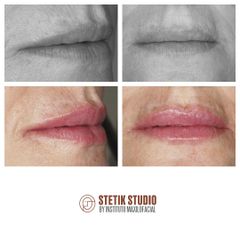 Aumento labios - Stetik Studio