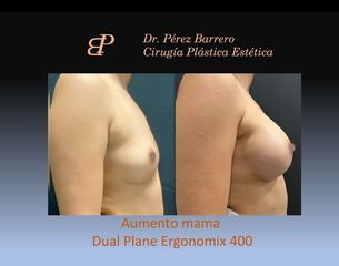 Aumento de pecho - Dr. Pérez Barrero