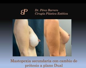 Mastopexia - Dr. Pérez Barrero