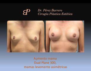 Aumento de pecho - Dr. Pérez Barrero