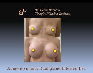 Aumento de pecho - Dr. Pérez Barrero
