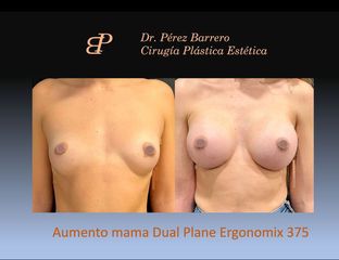 Aumento de pecho - Dr. Pérez Barrero