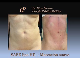 Liposucción - Dr. Pérez Barrero