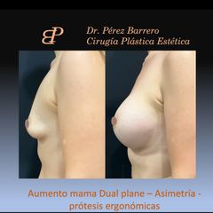 Aumento de pecho - Dr. Pérez Barrero