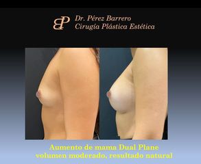 Aumento de pecho - Dr. Pérez Barrero