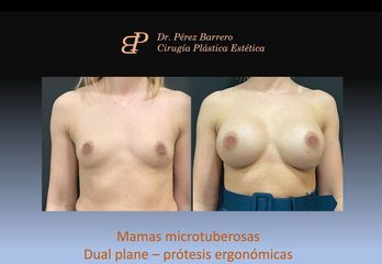 Aumento de pecho - Dr. Pérez Barrero