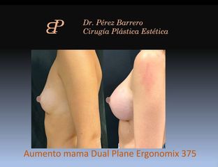 Aumento de pecho - Dr. Pérez Barrero