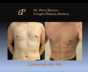 Liposucción - Dr. Pérez Barrero