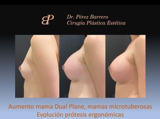 Aumento de pecho - Dr. Pérez Barrero