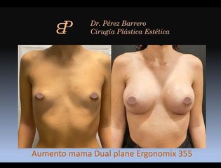 Aumento de pecho - Dr. Pérez Barrero