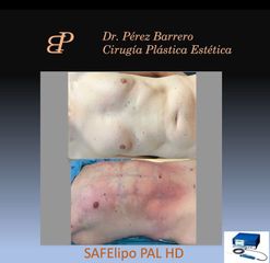 Liposucción - Dr. Pérez Barrero