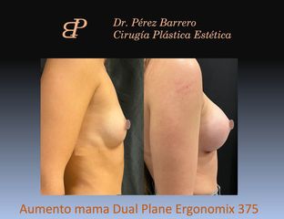 Aumento de pecho - Dr. Pérez Barrero