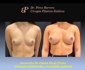 Aumento de pecho - Dr. Pérez Barrero